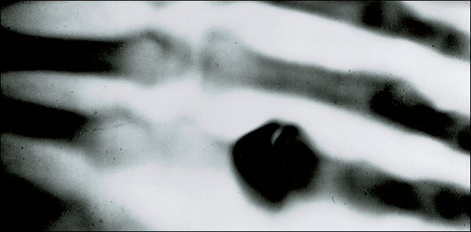  This is the first X-ray photograph, taken in December 1895, by Röntgen. It shows his wife’s hand – and the ring on her finger