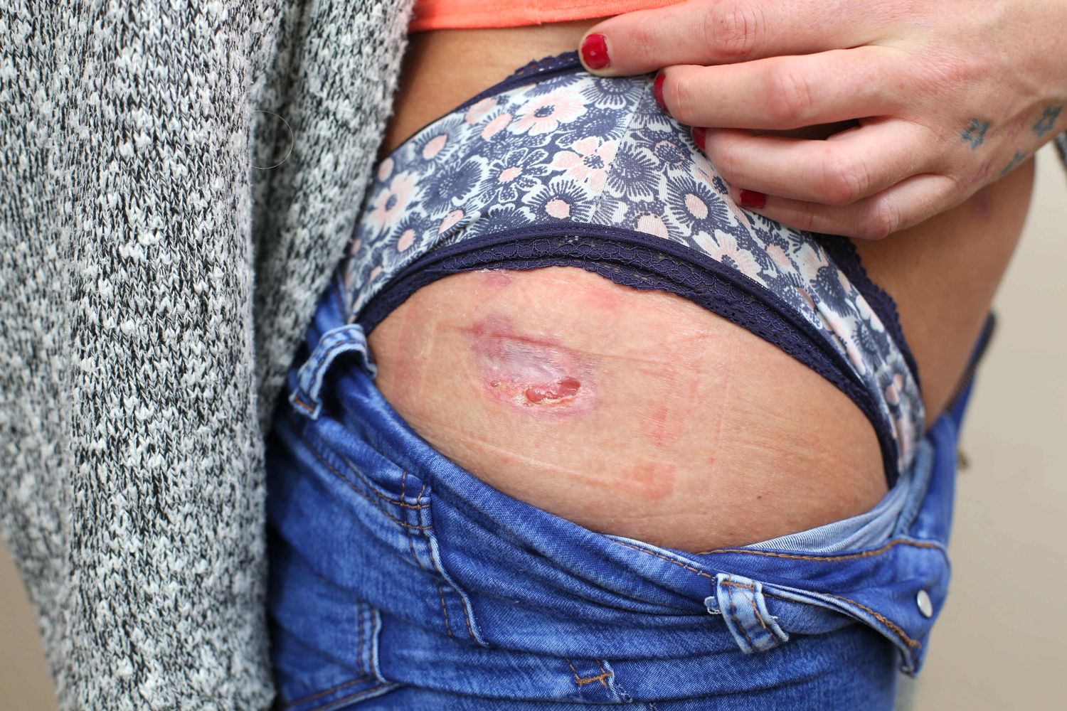 Lump ... Chantelle's body is covered in absesses after she injected herself 100 times