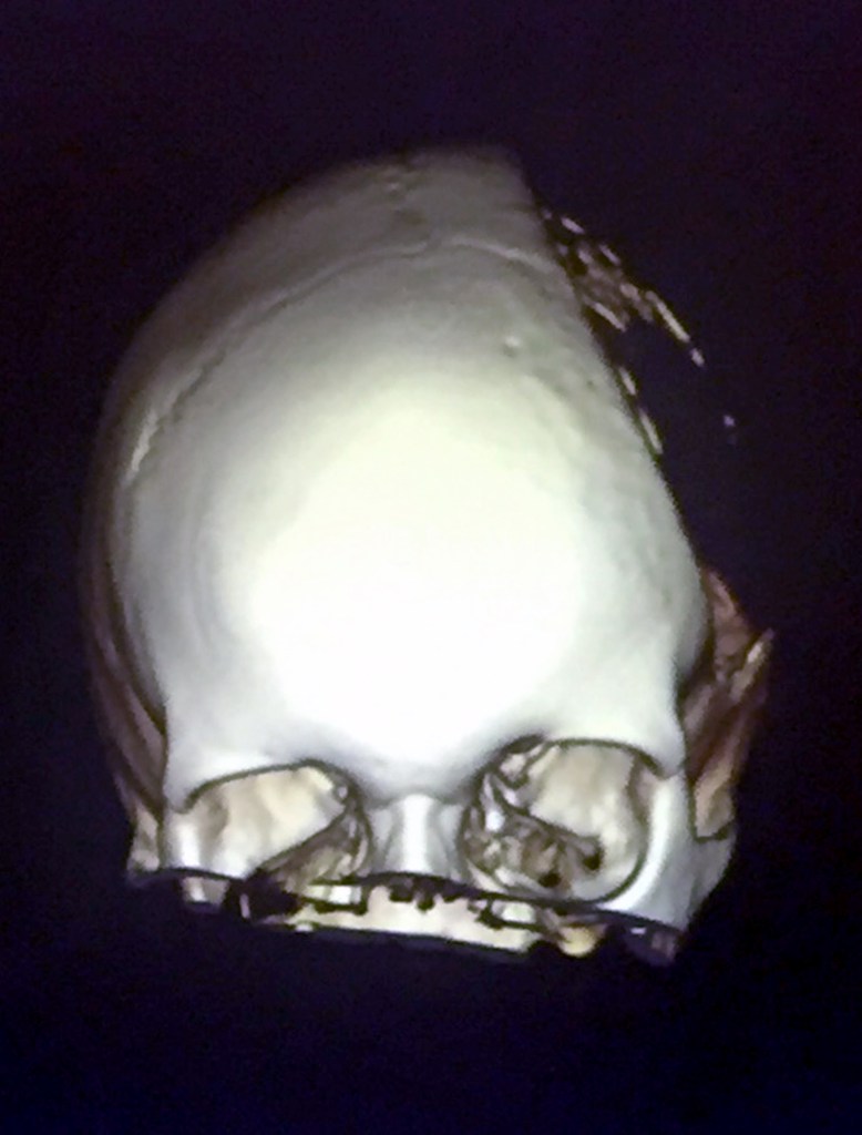 Surgeons removed a third of her skull to relieve the pressure on her brain and replaced it with a titanium plate