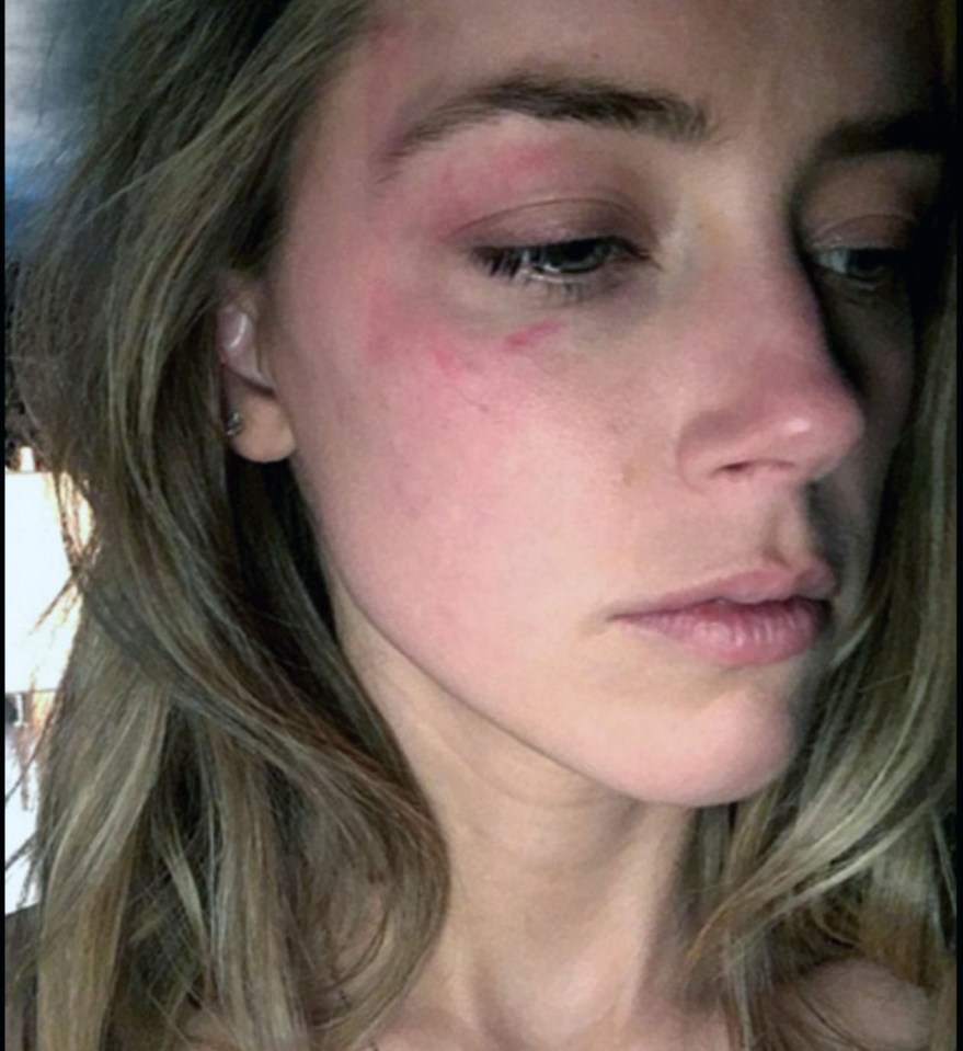  Photos of Amber's injuries, said to be caused after Johnny threw a phone at her, have appeared online