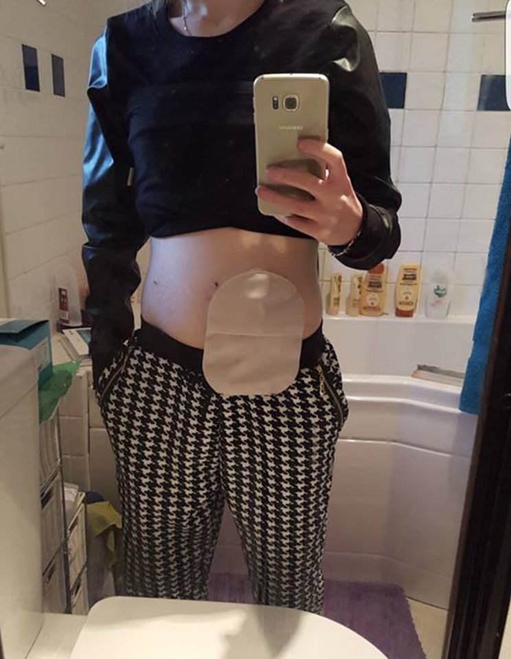  Nakisha recalled how after coming round from the surgery she 'shuddered' on first seeing her stoma bag