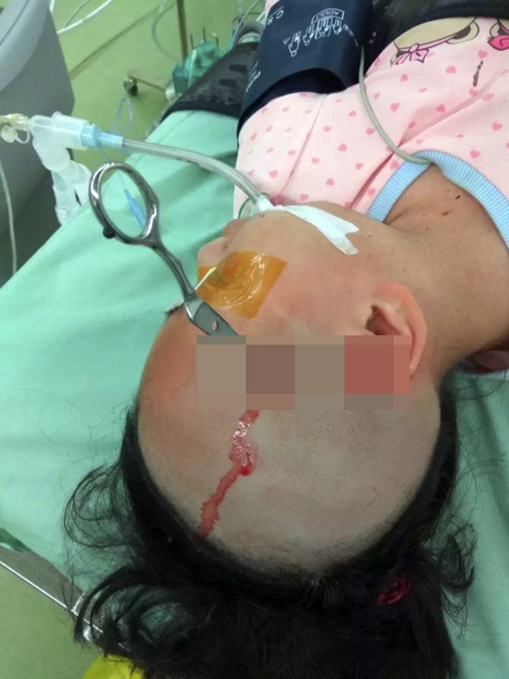  Surgeons cut away part of her skull in a difficult operation to remove the blade