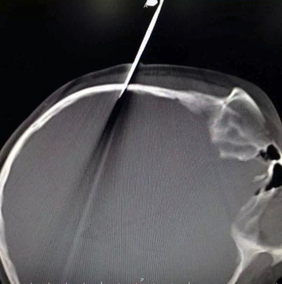  X-ray shows the blade lodged in the child's brain