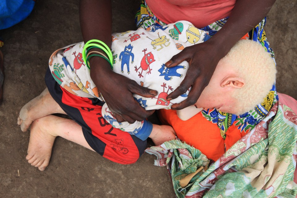  Edna is terrified the attackers will return for her other son who has albinism