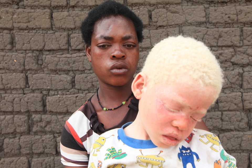  Edna, 26, holds her surviving albino son after his twin brother was slaughtered by witch doctors