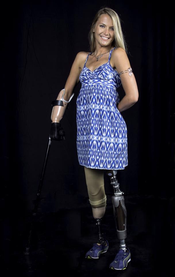  Despite losing her limbs, Aimee says her confidence level has never been higher