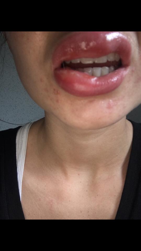  The teen thought the swelling would go down but the next day her mouth was in agony and she sought help from her GP and a chemist but unfortunately their advice didn't help