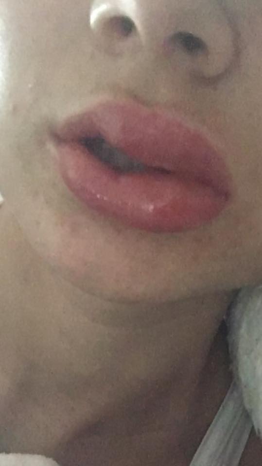  A teen suffered third degree burns, swollen lips and serious blisters after she underwent a teeth whitening treatment