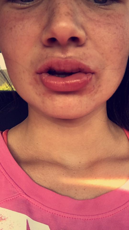  Abbie Kilbride noticed her lips were slightly swollen after she went to a local woman for the cosmetic procedure