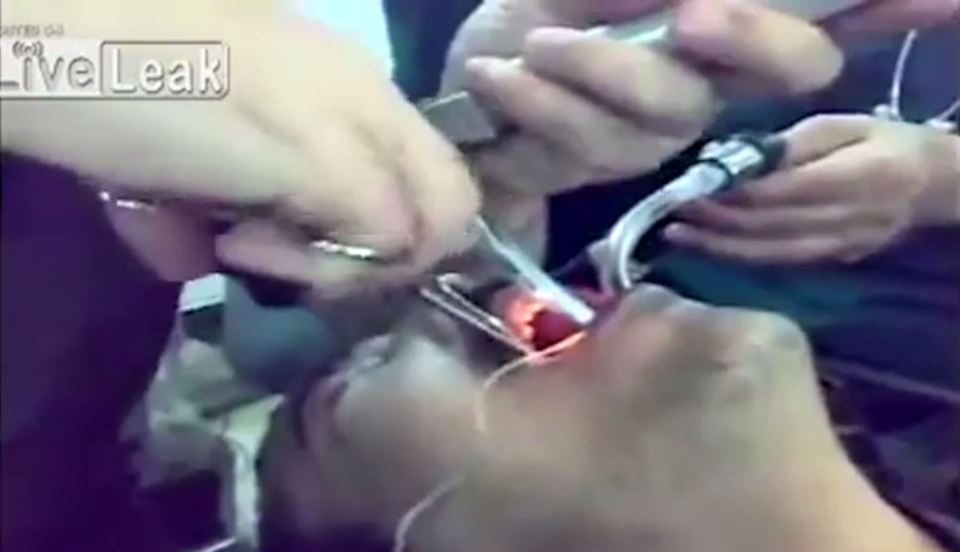  Metal instruments were used to try and keep the man's mouth open during the tricky procedure