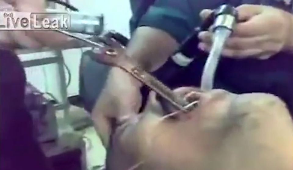  Incredible video footage shows the moment that a man has a huge spanner pulled from his throat