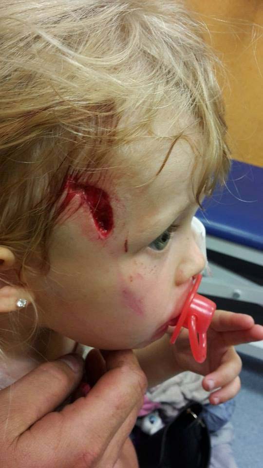  The tot could be scarred for life after sustaining a horrific gash to her temple