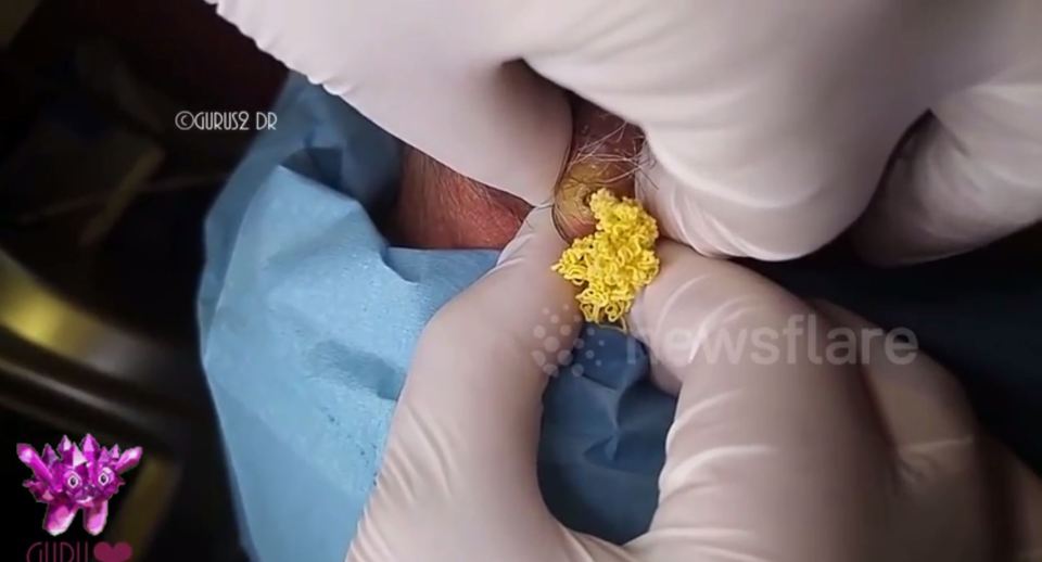  The cyst, which was located on the back of a man's neck, seemed to have a lot of yellow pus