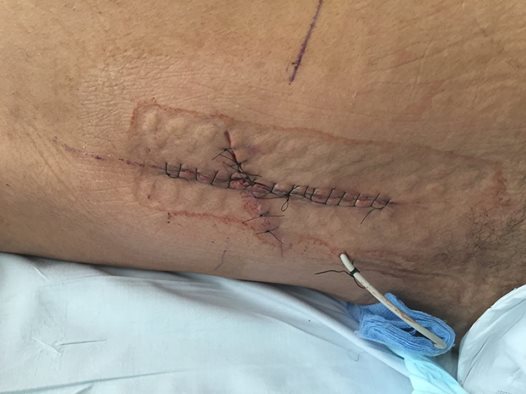  Doctors say the blade snapped off just millimetres from the spine