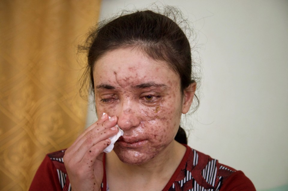  Lamiya was left permanently scarred when a mine blew up as she fled her captors