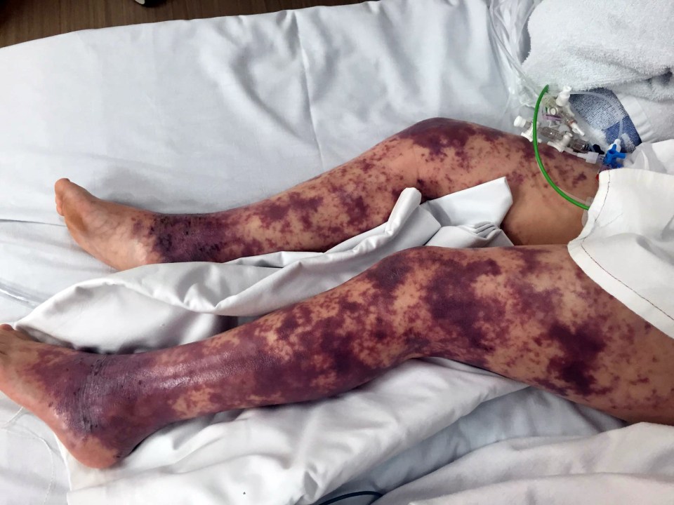  The rash pictured as it took over Brogan-Lei's legs