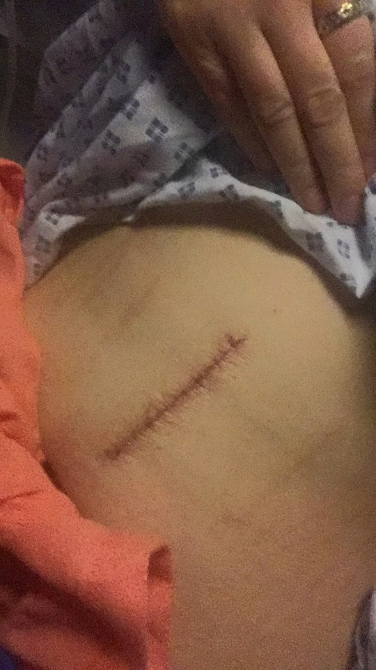  The surgery left Sophie with a huge scar