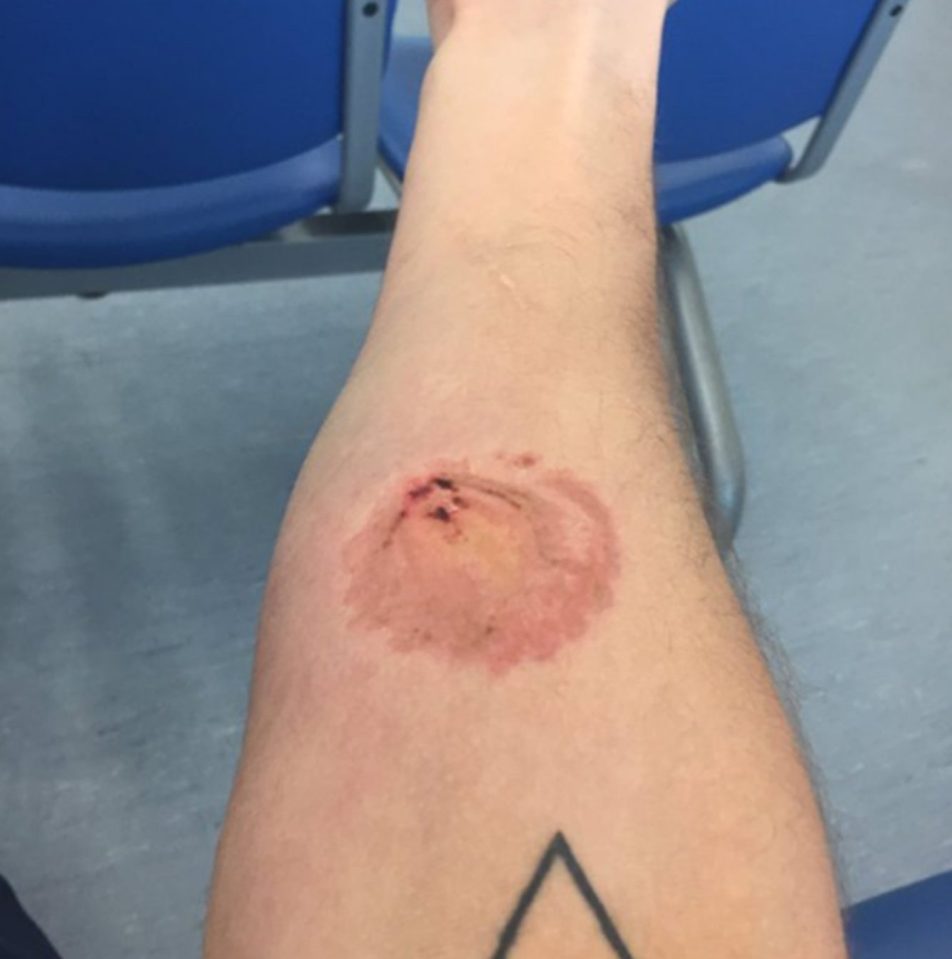  Chris posted about his experience on social media - showing his bite mark here left on his arm by McCarthy