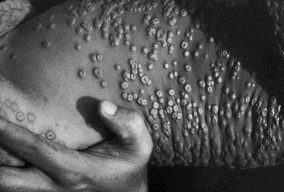  Smallpox lesions on skin are shown in this photograph taken in 1973 in Bangladesh. Smallpox infection was eliminated from the world in 1977