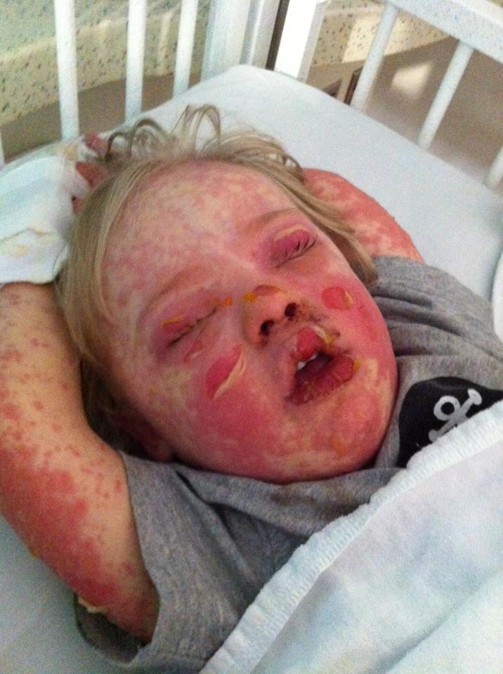  Kai Kehm's skin peeled off just days after he started taking the medication for an infection