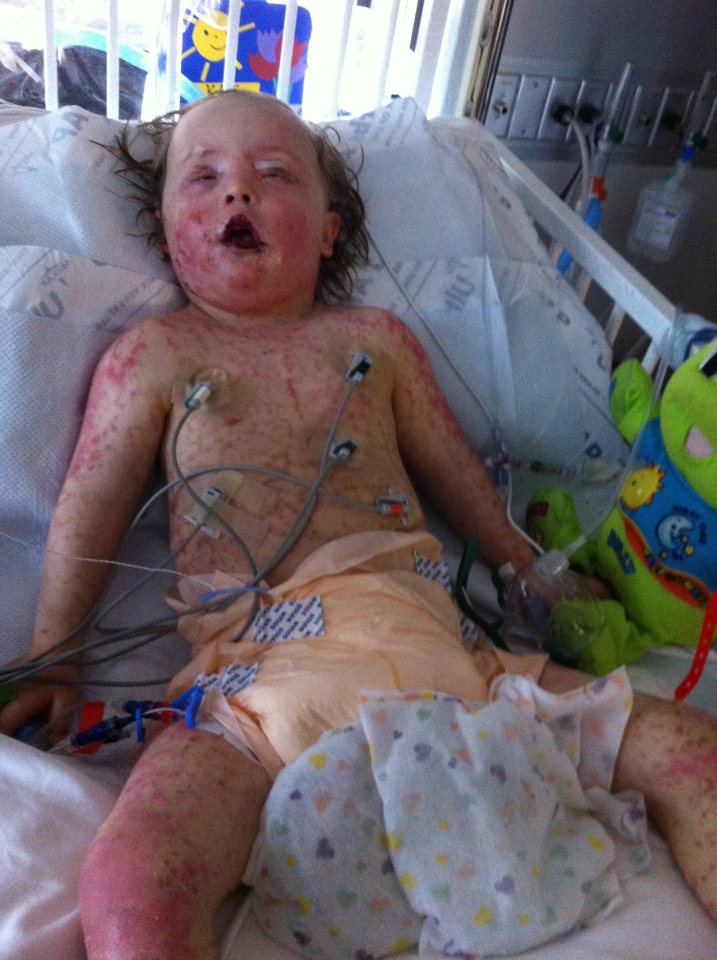  Kai was actually suffering with Stevens-Johnson syndrome, a rare reaction to a medication