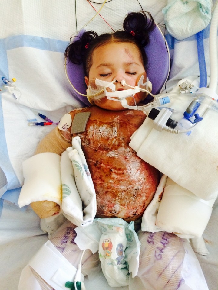  The then three-year-old suffered third degree burns which affect 60 per cent of her body