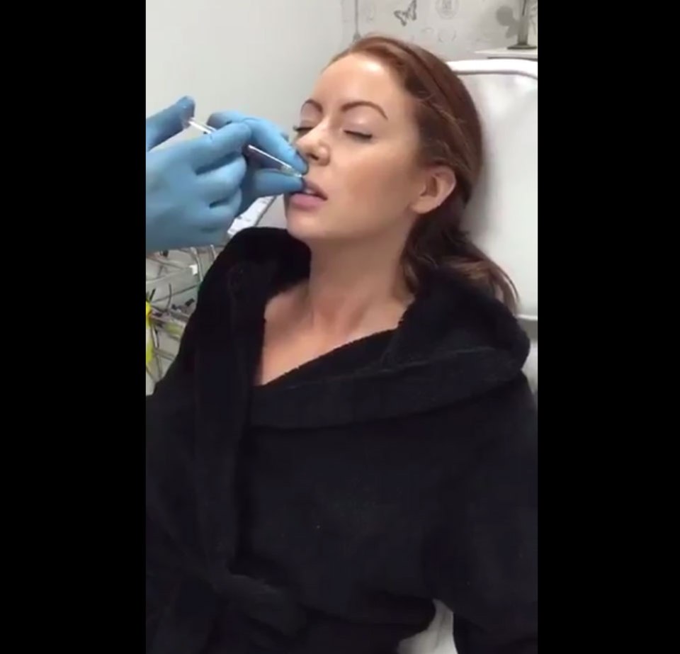  Laura Carter has her lip fillers done live on camera