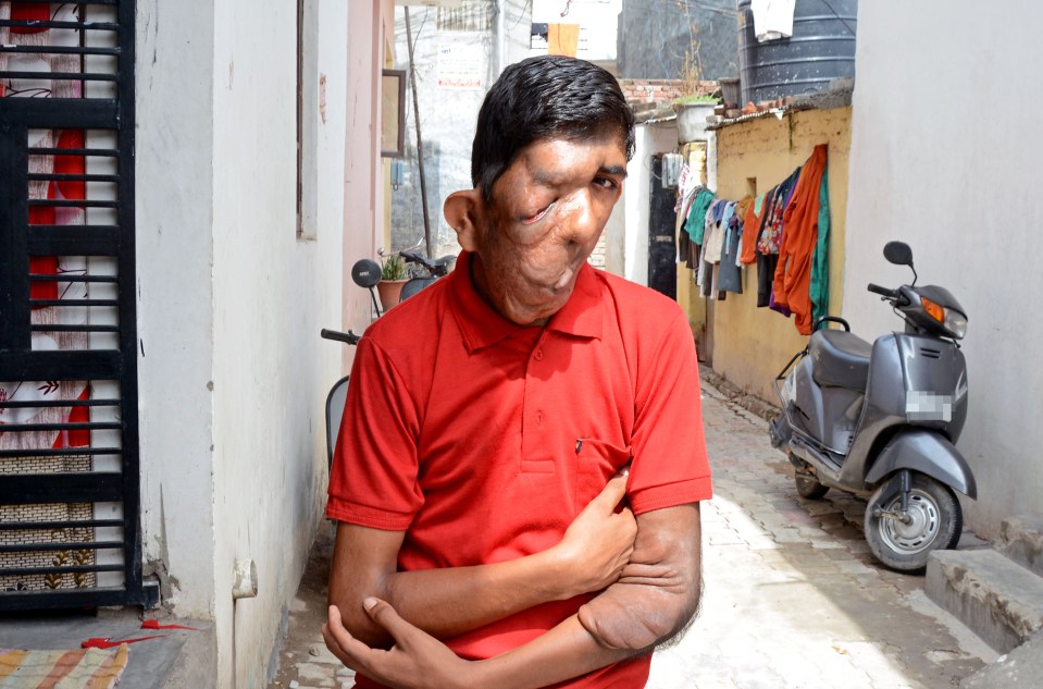  Bhupinder Singh lives virtually as a recluse after he was shunned from school because of his unusual appearance