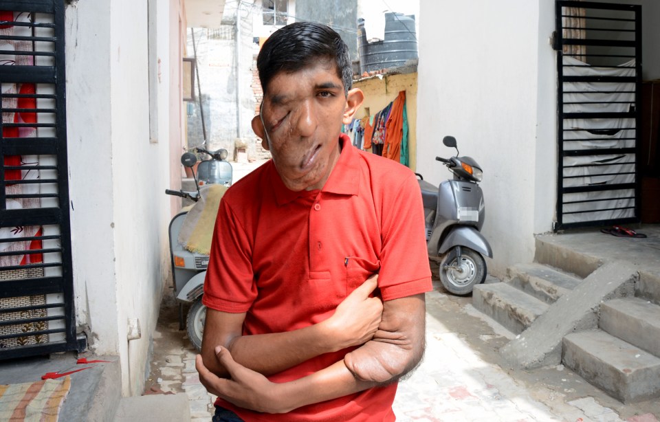  Bhupinder was born with a small tumour on his right eyelid