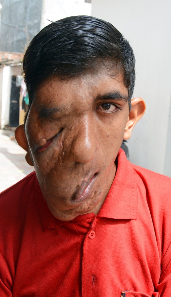  This teenager has a sagging face from a rare condition, which has left him too scared to leave his village due to cruel taunts and comments from strangers