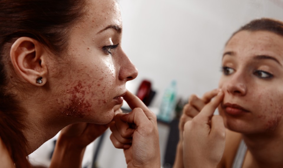  More and more women are struggling with adult acne