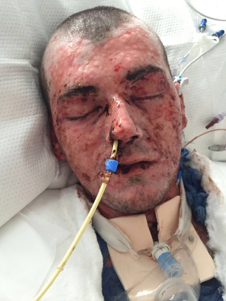  The 21-year-old was admitted into intensive care with blisters and burns all over his body