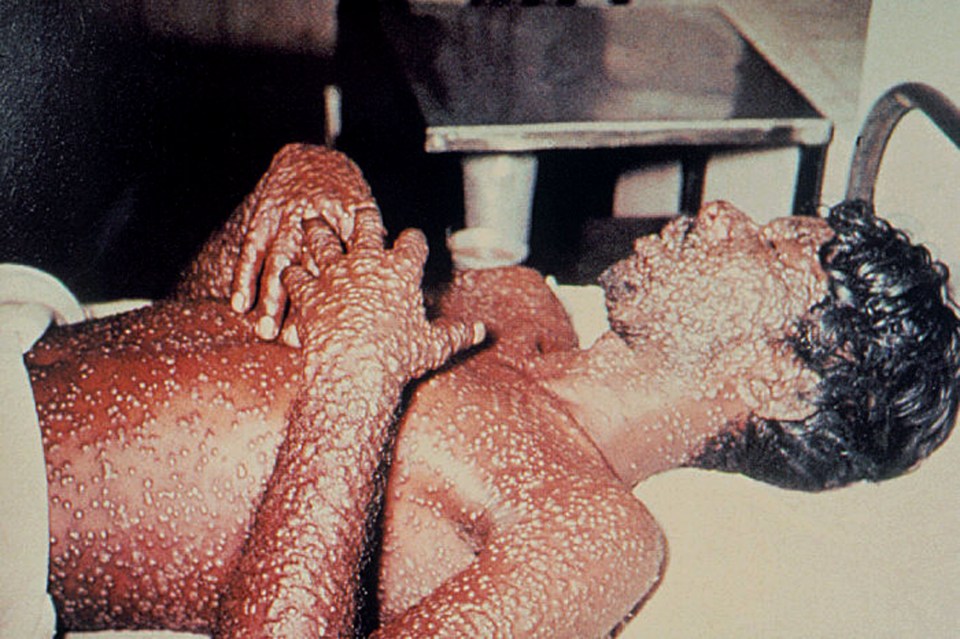  In the 20th century smallpox was responsible for between 300-400 million people being killed