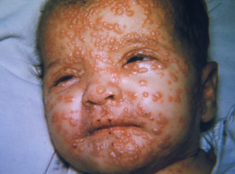 Smallpox killed about 30 per cent of those it infected