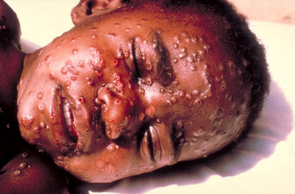  A victim of the smallpox, which is a contagious disease