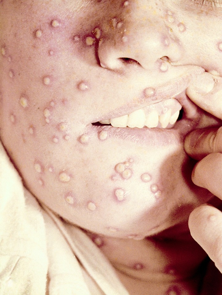  If you have contracted smallpox, initially, your face and skin will break out in a rash and this will develop into pus-filled blisters