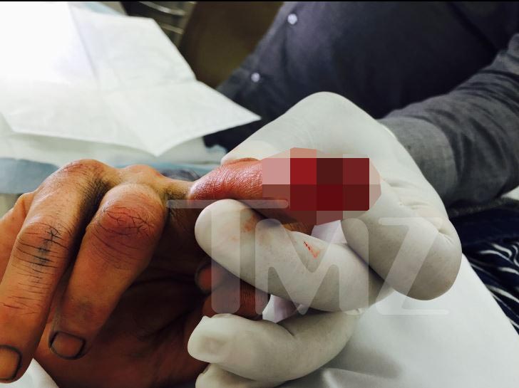  Another photo allegedly shows Johnny's injured finger, which Amber says he sliced by accident as he smashed bottles and windows in a fit of rage