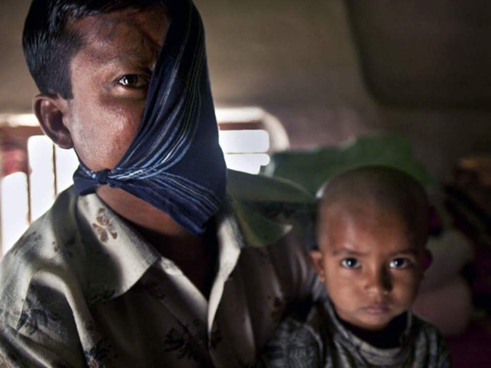  Hashmot fears his disfigurement will mean his daughter will struggle to find a husband