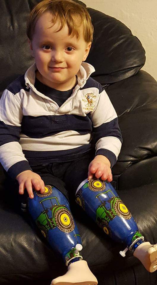 Now 'Mr Positive' is recovering and learning to walk on his new legs