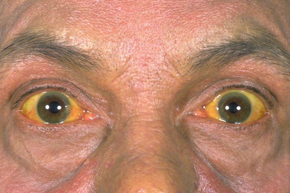 One of the symptoms of jaundice is yellow skin or whites of eyes