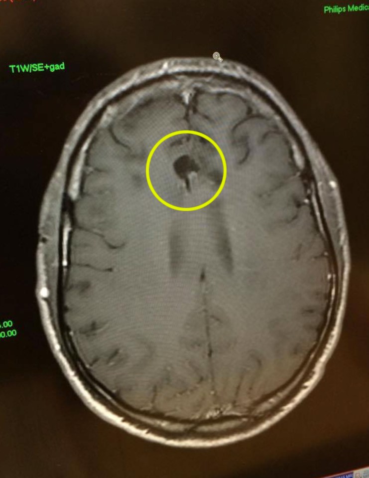  Dave's most recent scan , in June this year, revealed there was not much of the mass left