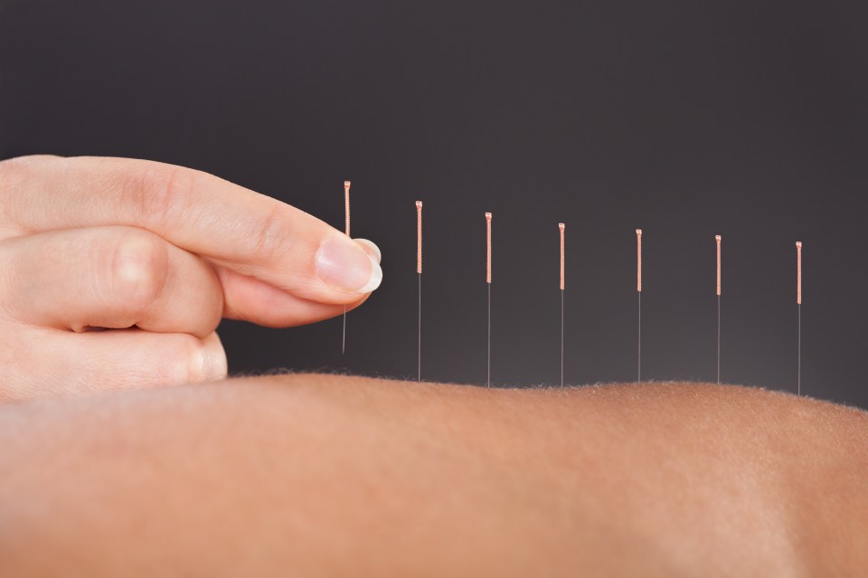  Pin-trest ... acupuncture can cause the brain to release feel-good endorphins