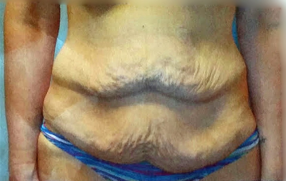  After her weight loss she was left with unsightly excess skin