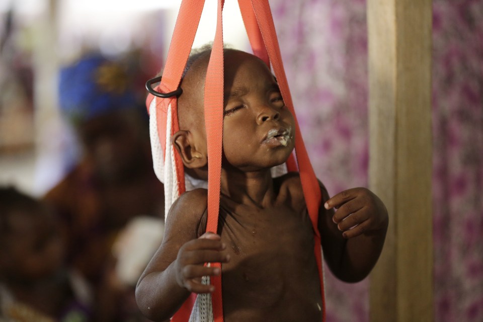  Doctors Without Borders attempt to alleviate hunger pain ... a tiny, starving tot is placed in a harness to be weighed