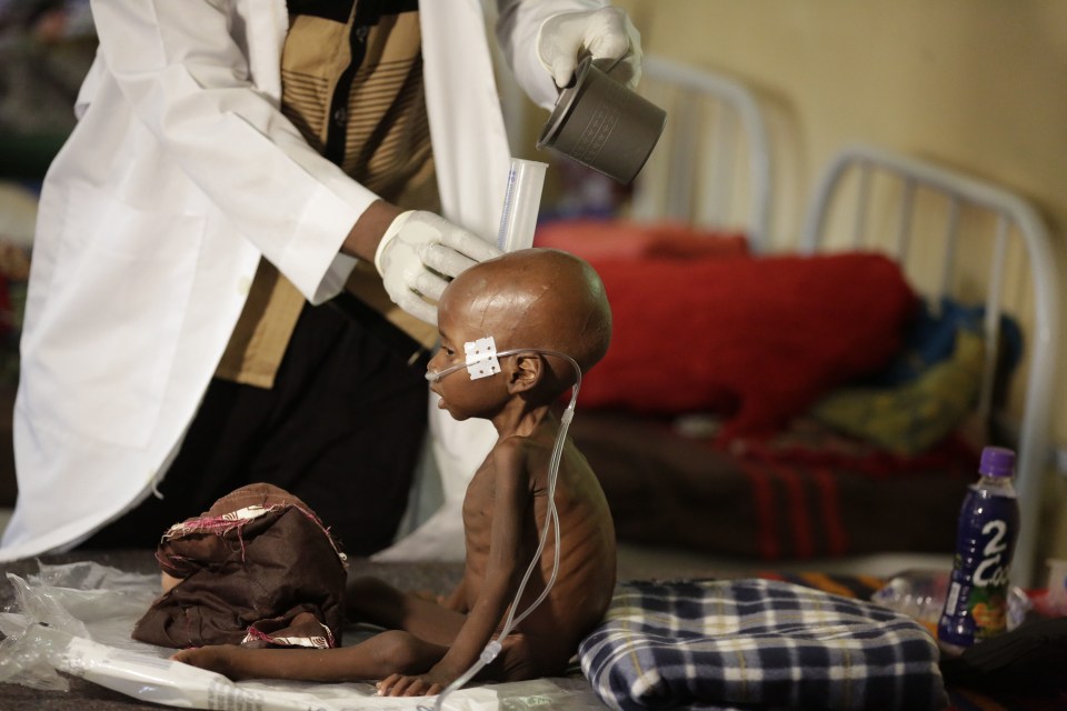  Escaped the clutches of Boko Haram for this ... a young, starving child at the feeding centre in Nigeria