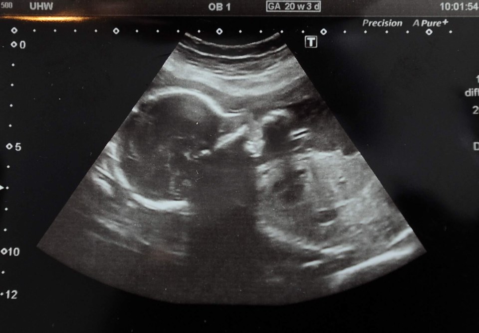  A scan of one of the triplets