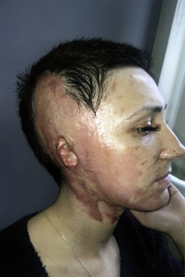  Adele Bellis is backing calls to change the law following an acid attack that left her scarred for life