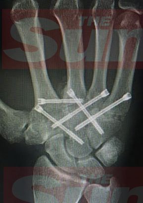  Ouch! Khan's broken hand