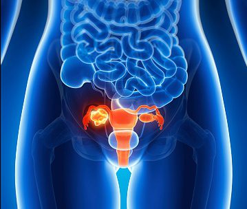  A new study has revealed fewer women are dying from ovarian cancer than a decade ago