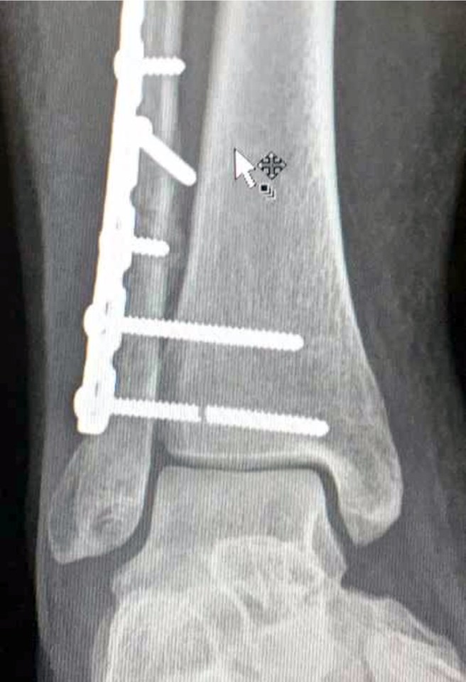 The 19-year-old had five screws inserted into her leg to help heal the large break she sustained 